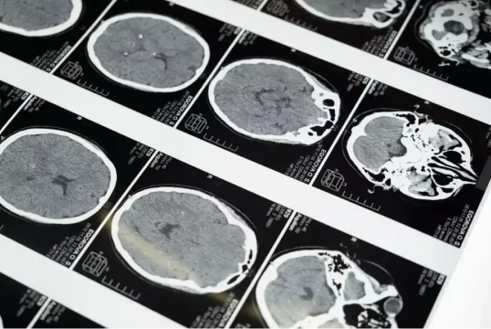 Brain Injury